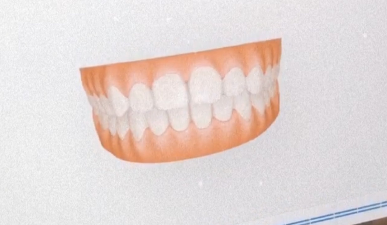 3D demo scans to show how my teeth should look post-Invisalign 