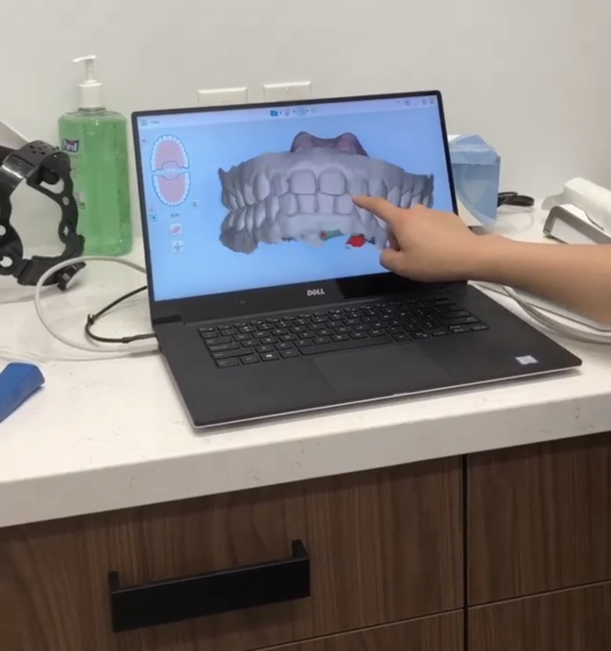 3D scans of my teeth before I started my Invisalign treatment